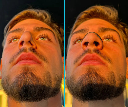 Before and after for using the Respiro Nose Strip (showing the benefits)